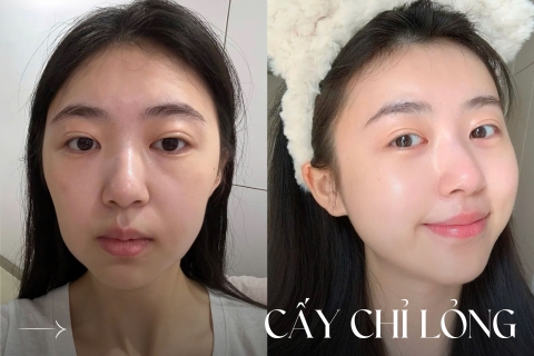 Cấy chỉ lỏng